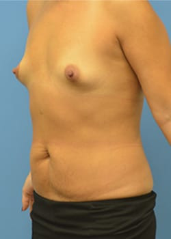 Tummy Tuck