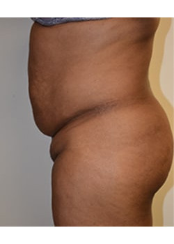 Tummy Tuck