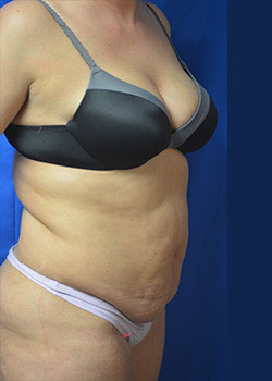 Tummy Tuck