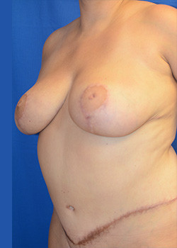 Tummy Tuck