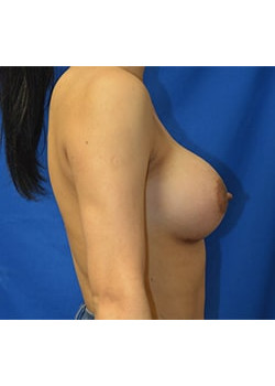 Breast Augmentation