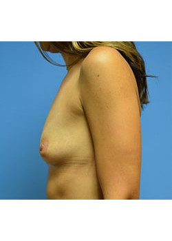 Breast Augmentation