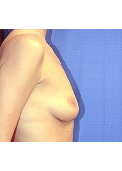 Breast Augmentation