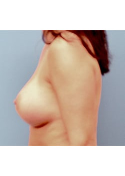 Breast Augmentation