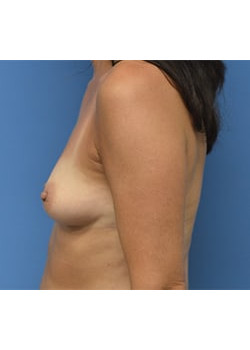 Breast Augmentation