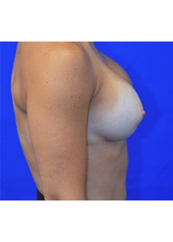 Breast Augmentation