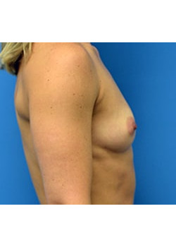 Breast Augmentation