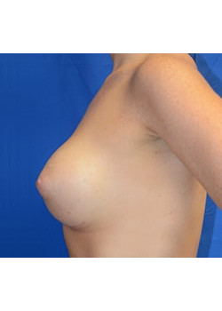 Breast Augmentation