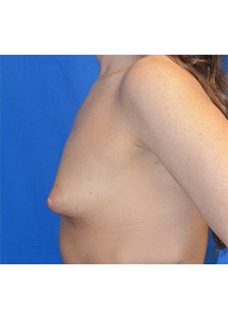 Breast Augmentation