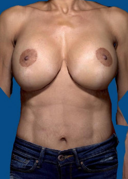 breast augmentation mastopexy