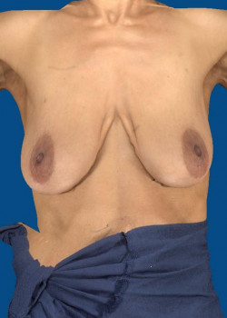 breast augmentation mastopexy