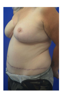 Breast Reconstruction