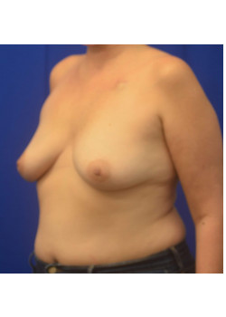 Breast Reconstruction : Bilateral Pre pectoral Direct to Implant Reconstruction