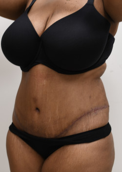 Tummy Tuck