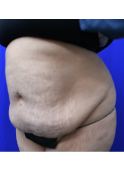 Tummy Tuck