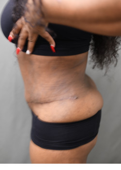 Tummy Tuck