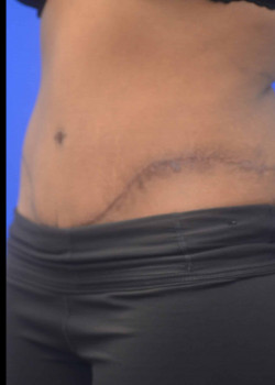 Tummy Tuck