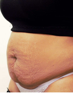 Tummy Tuck