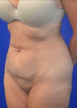 Tummy Tuck