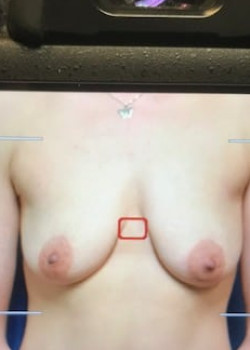 Breast Augmentation with lift