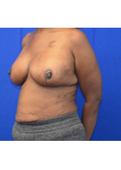 Breast Reconstruction