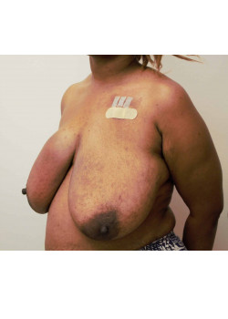 Breast Reconstruction