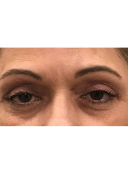 Blepharoplasty