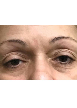 Blepharoplasty