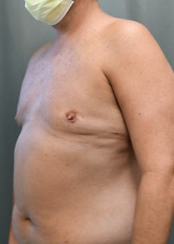 Gynecomastia