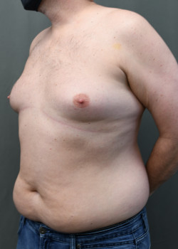 Gynecomastia