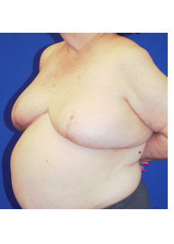 Breast Reconstruction