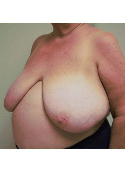 Breast Reconstruction