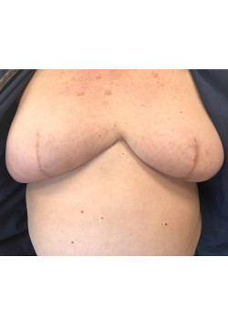 Nipple Tattoo after Breast Reconstruction