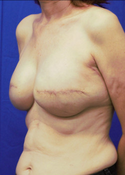 Breast Reconstruction