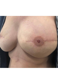 Nipple Tattoo after Breast Reconstruction