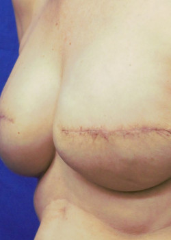 Nipple Tattoo after Breast Reconstruction