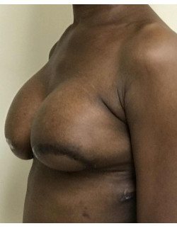 Breast Reconstruction