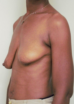 Breast Reconstruction