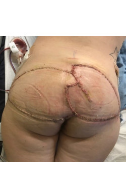 Complex Sacral Wound Reconstruction