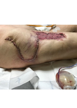 Complex Hip Wound Reconstruction