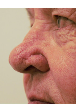 Nose Reconstruction Bilobe Flap