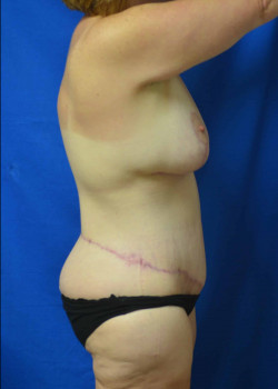 Surgery After Massive Weight Loss: Breast Lift and Lower Body Lift