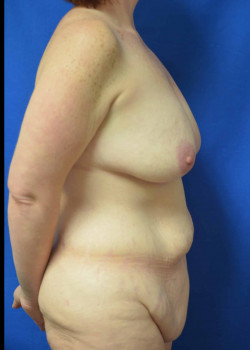 Surgery After Massive Weight Loss: Breast Lift and Lower Body Lift