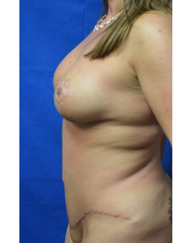 Mommy Makeover: Breast Lift with Implants and Abdominoplasty