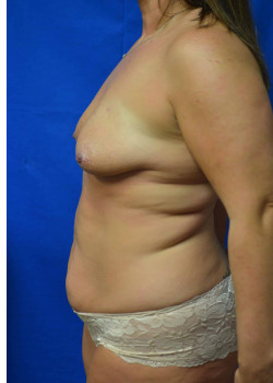 Mommy Makeover: Breast Lift with Implants and Abdominoplasty