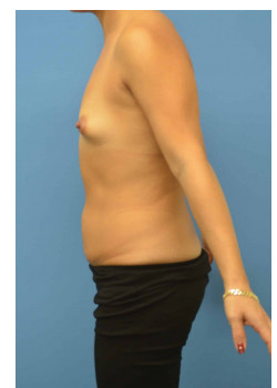 Mommy Makeover: Breast Augmentation and Abdominoplasty