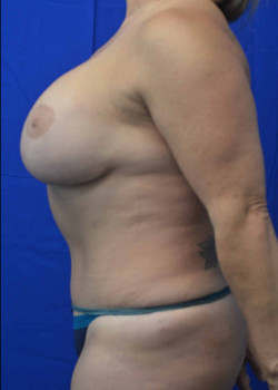 Mommy Makeover: Breast Reduction and Abdominoplasty