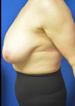 Mommy Makeover: Breast Reduction and Abdominoplasty