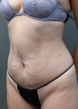 Tummy Tuck