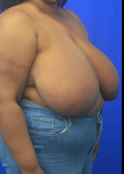 Breast Reduction